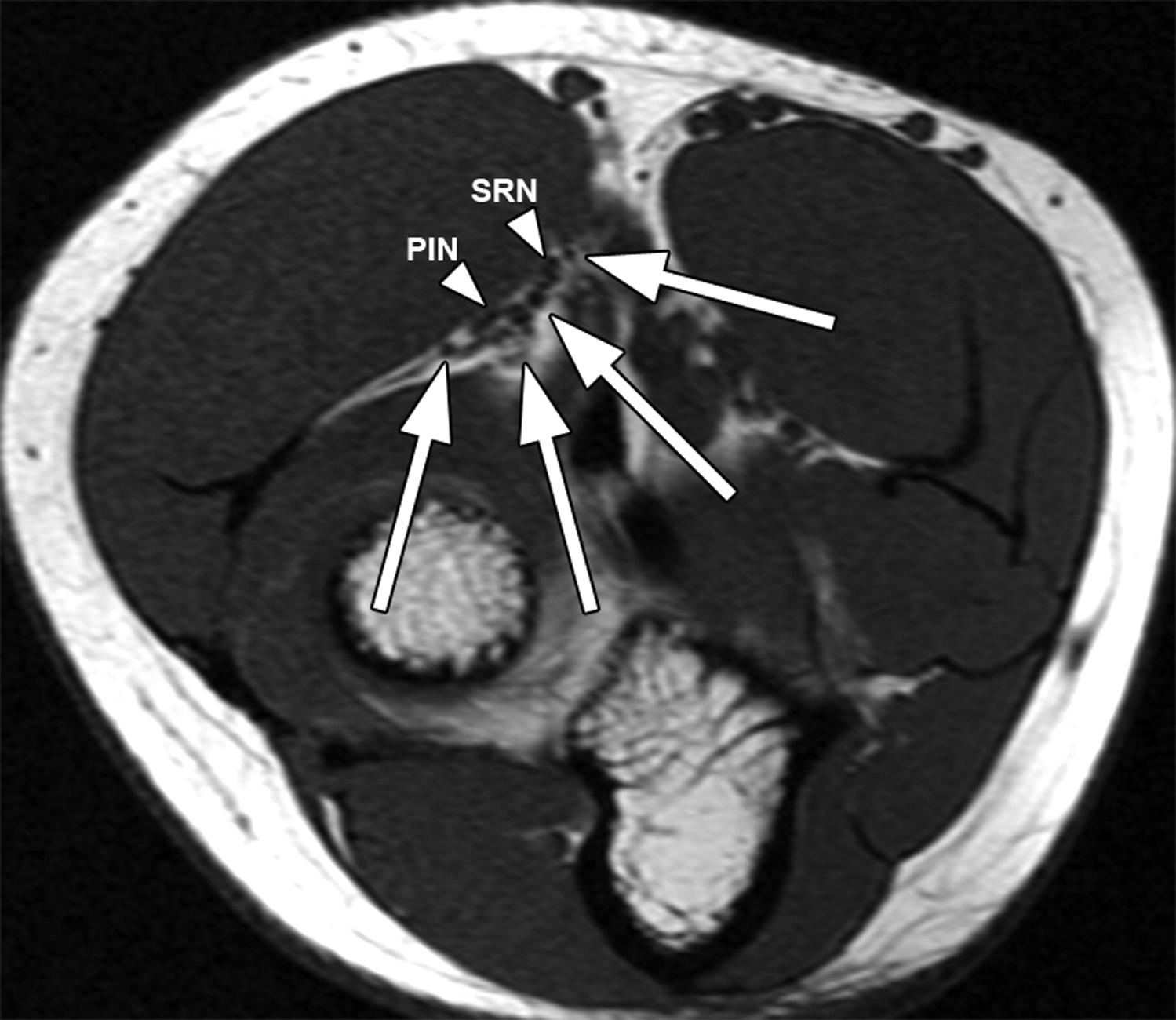 Radial Tunnel Syndrome Hand Orthobullets